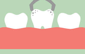 tooth extraction