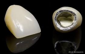 dental crowns