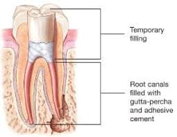 root canal 